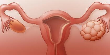 Ovaio policistico: Berberina un valido supporto? | Gruppo FarmaImpresa