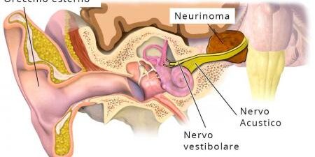 Disturbi vestibolari: i nutraceutici migliorano i sintomi?