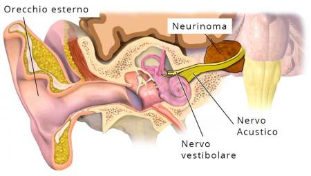 Disturbi vestibolari: i nutraceutici migliorano i sintomi?